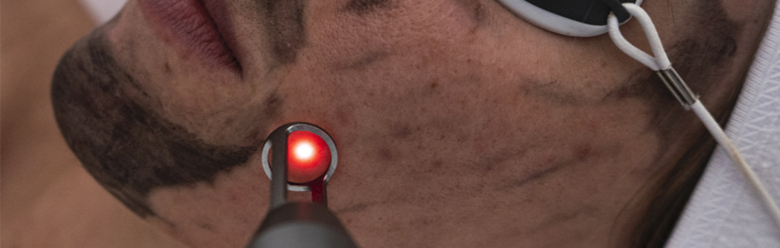 Woman receiving professional Tattoo Removal treatment