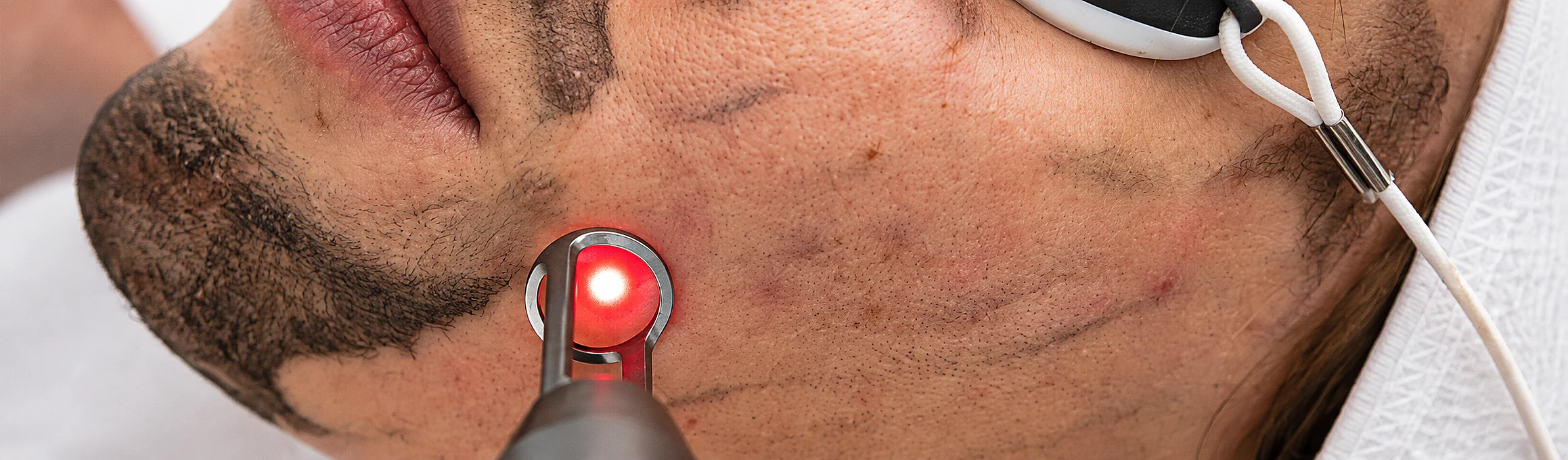 Carbon Facial